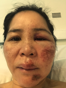 Nova recovering from concussion — the turning point that led to MindTonic